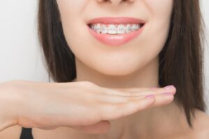 Come funziona l’apparecchio ortodontico?
