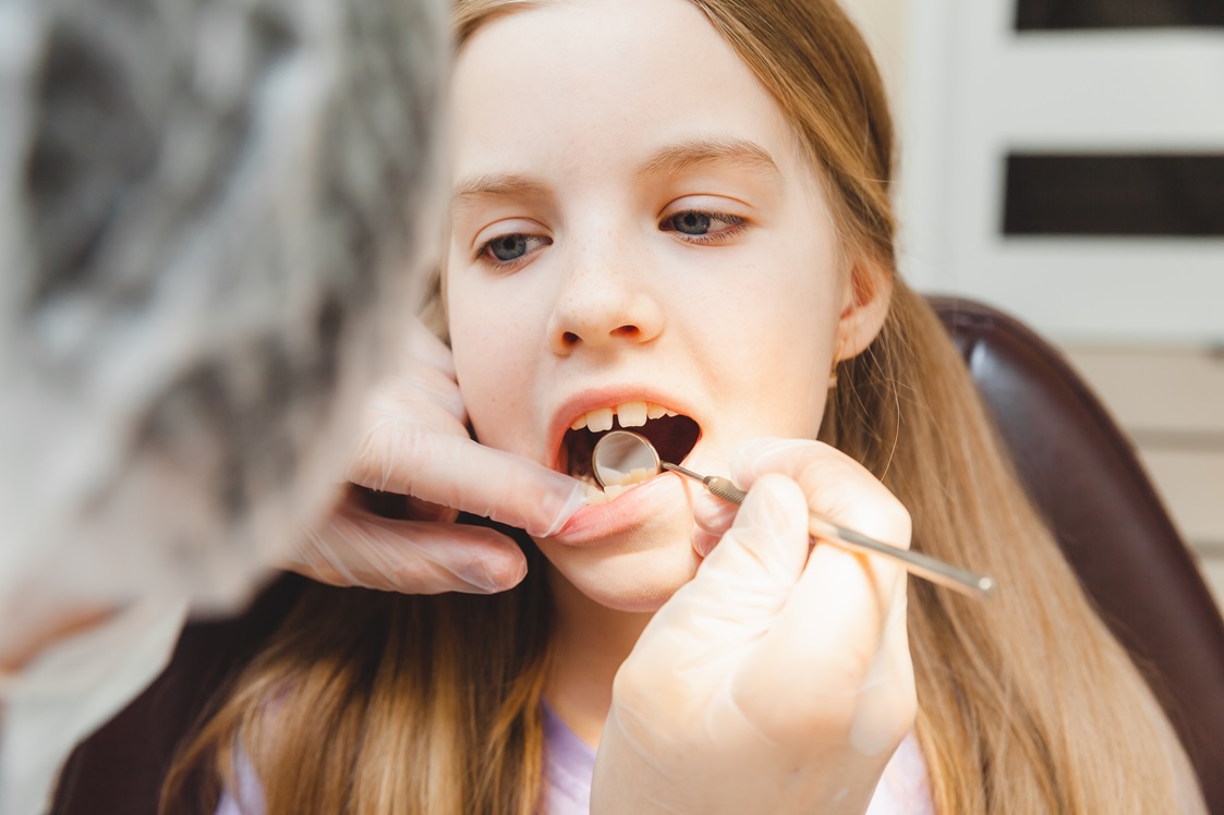 Le mamme chiedono: cosa posso fare per prevenire la carie di mio figlio?