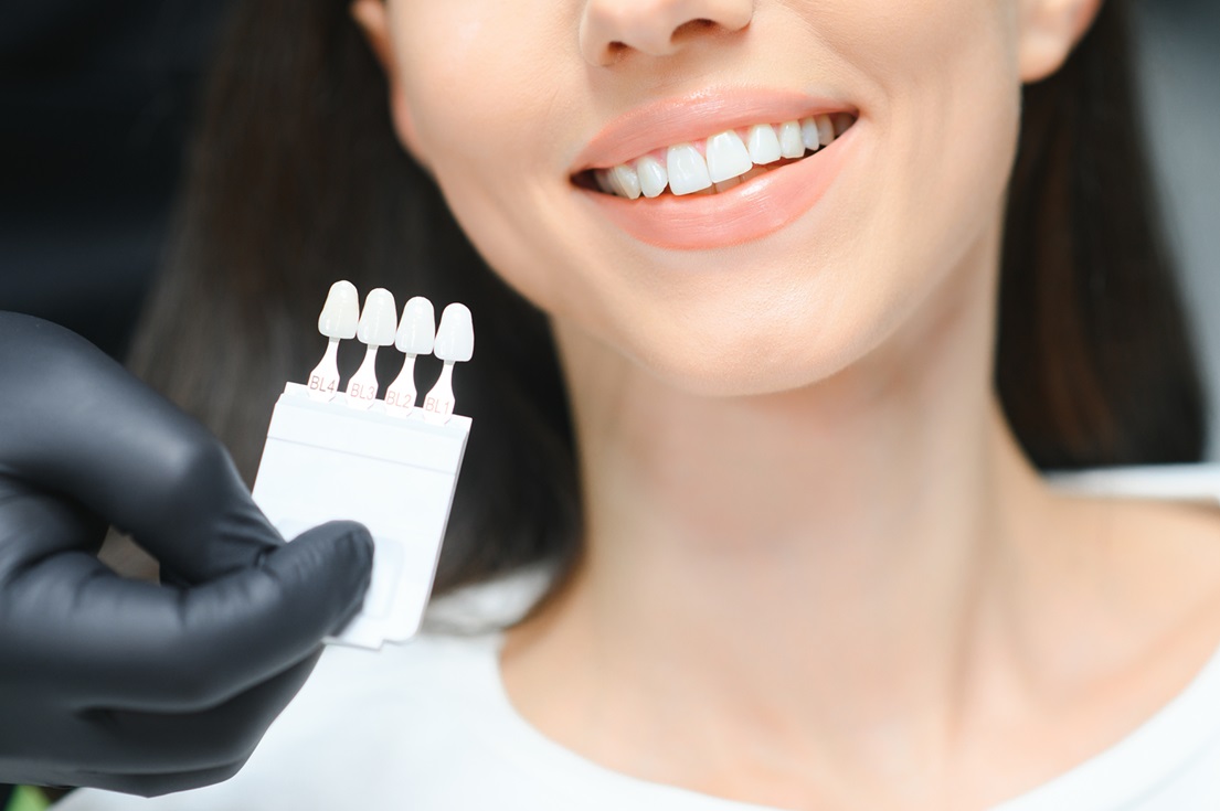 Correggere le imperfezioni dentali con le faccette